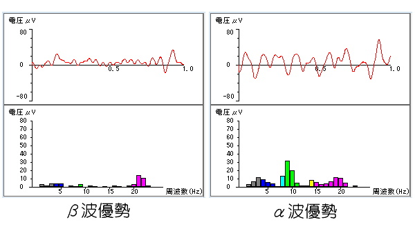 β波優勢とα波優勢の比較。脳波の原波形と周波数スペクトル棒グラフ。